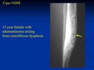 Case #1094




15 year female with
adamantinoma arising
from osteofibrous dysplasia
 