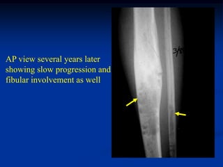 AP view several years later
showing slow progression and
fibular involvement as well
 