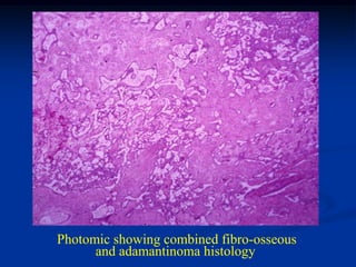 Photomic showing combined fibro-osseous
      and adamantinoma histology
 