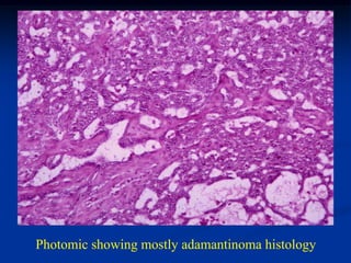 Photomic showing mostly adamantinoma histology
 