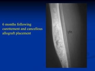 6 months following
curettement and cancellous
allograft placement
 