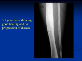 3.5 years later showing
good healing and no
progression of disease
 