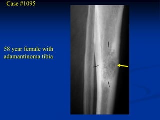 Case #1095




58 year female with
adamantinoma tibia
 