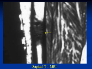 Sagittal T-1 MRI
 