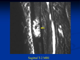 Sagittal T-2 MRI
 
