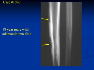 Case #1096




18 year male with
adamantinoma tibia
 