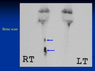 Bone scan
 