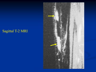 Sagittal T-2 MRI
 
