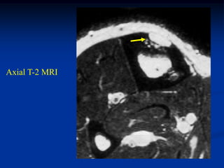 Axial T-2 MRI
 