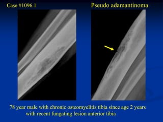 Case #1096.1                          Pseudo adamantinoma




 78 year male with chronic osteomyelitis tibia since age 2 years
        with recent fungating lesion anterior tibia
 