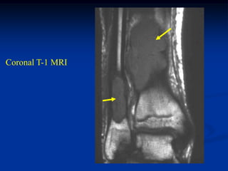 Coronal T-1 MRI
 