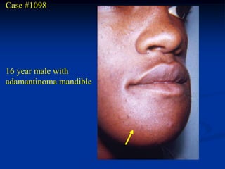 Case #1098




16 year male with
adamantinoma mandible
 