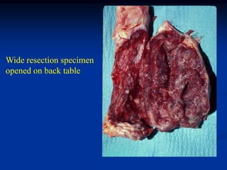 Wide resection specimen
opened on back table
 
