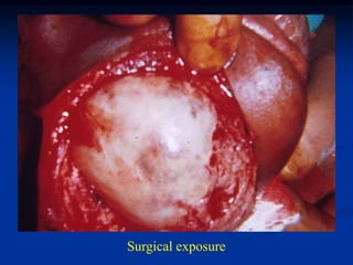 Surgical exposure
 