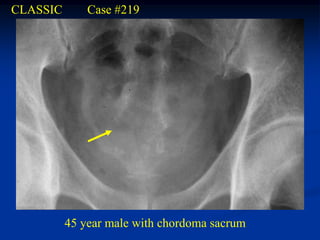CLASSIC       Case #219




          45 year male with chordoma sacrum
 