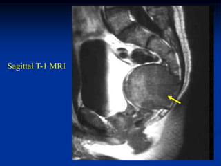 Sagittal T-1 MRI
 