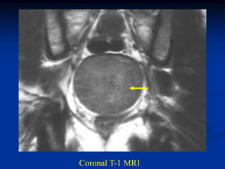 Coronal T-1 MRI
 