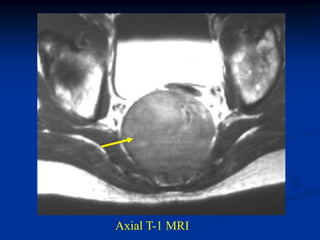 Axial T-1 MRI
 