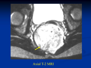 Axial T-2 MRI
 