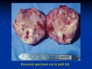 Resected specimen cut in path lab
 