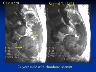 Case #220                 Sagittal T-1 MRI




        74 year male with chordoma sacrum
 