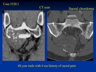 Case #220.1
                          CT scan                Sacral chordoma




          48 year male with 4 mo history of sacral pain
 
