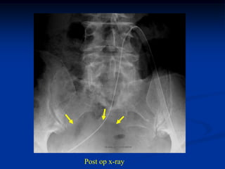 Post op x-ray
 