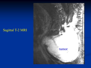 Sagittal T-2 MRI




                   tumor
 