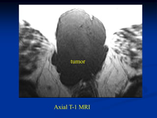 tumor




Axial T-1 MRI
 