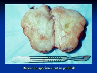 Resection specimen cut in path lab
 