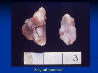 Surgical specimen
 
