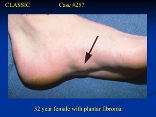 CLASSIC            Case #257




          32 year female with plantar fibroma
 