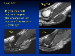 Case #257.1              Sag T-1

48 year male with
recurrent lump on
plantar aspect of foot
recurrent from surgery
17 years ago

    T-2                  Gad
 