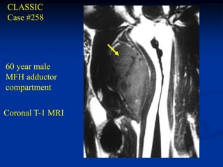 CLASSIC
Case #258




60 year male
MFH adductor
compartment

Coronal T-1 MRI
 