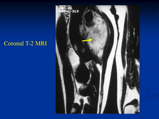 Coronal T-2 MRI
 