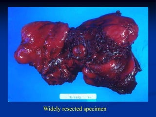 Widely resected specimen
 