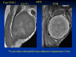 Case #258.1                  MFH
               Cor T-1                      STIR




    74 year male with painful mass adductor compartment 3 mos
 