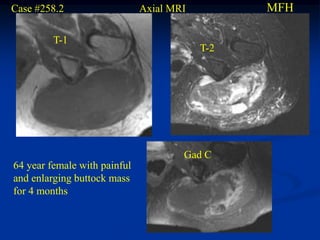 Case #258.2                   Axial MRI         MFH

         T-1
                                          T-2




                                      Gad C
64 year female with painful
and enlarging buttock mass
for 4 months
 