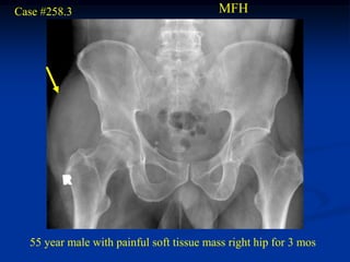 Case #258.3                               MFH




  55 year male with painful soft tissue mass right hip for 3 mos
 