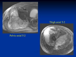 Thigh axial T-2




Pelvic axial T-2
 