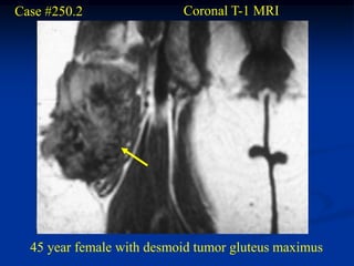 Case #250.2                Coronal T-1 MRI




  45 year female with desmoid tumor gluteus maximus
 