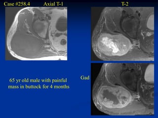 Case #258.4      Axial T-1            T-2




                                Gad
 65 yr old male with painful
 mass in buttock for 4 months
 
