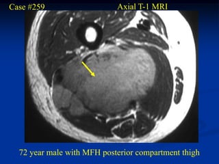 Case #259                   Axial T-1 MRI




  72 year male with MFH posterior compartment thigh
 