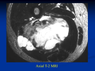 Axial T-2 MRI
 