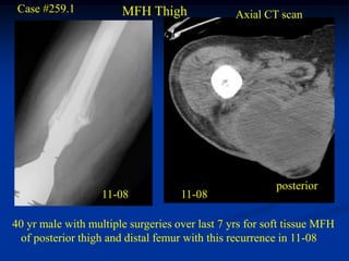 Case #259.1           MFH Thigh                Axial CT scan




                                                         posterior
                   11-08            11-08

40 yr male with multiple surgeries over last 7 yrs for soft tissue MFH
  of posterior thigh and distal femur with this recurrence in 11-08
 