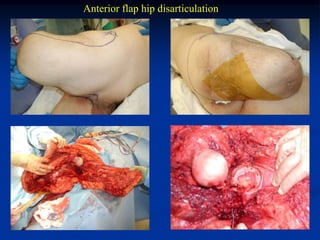 Anterior flap hip disarticulation
 