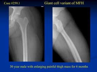 Case #259.1                   Giant cell variant of MFH




    30 year male with enlarging painful thigh mass for 6 months
 