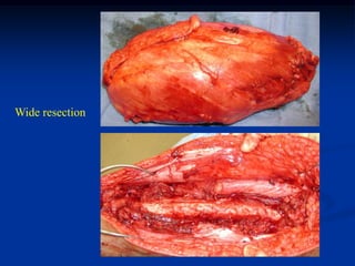 Wide resection
 