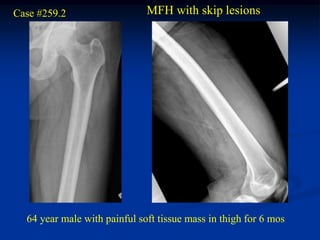 Case #259.2                   MFH with skip lesions




  64 year male with painful soft tissue mass in thigh for 6 mos
 