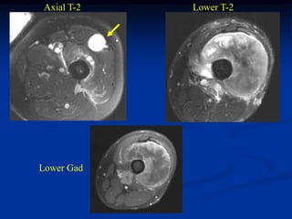 Axial T-2   Lower T-2




Lower Gad
 